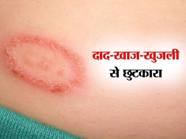 दाद, जानिए घरेलु उपाय