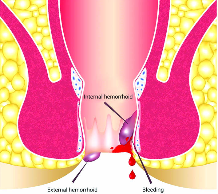 बवासीर लक्षण और उपचार